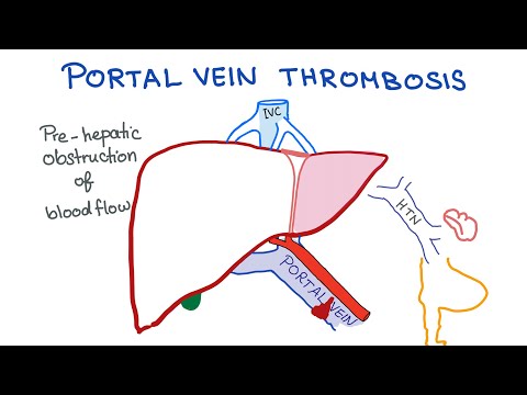 Portal Vein Thrombosis